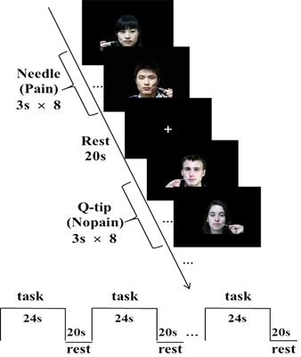 Racial Bias in Neural Response for Pain Is Modulated by Minimal Group